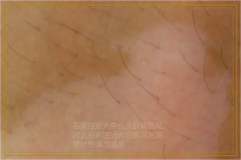 小孩脸上有白点图片