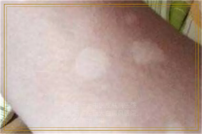 婴儿会不会一出生就得白癜风