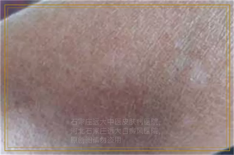 孩子四肢有很多小白点是怎么回事