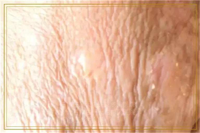 治疗儿童腹部白癜风选择什么方法