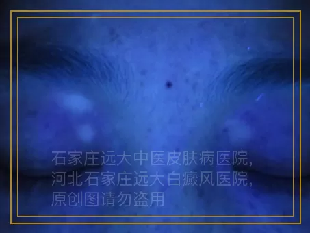 小孩白癜风能用光疗仪吗