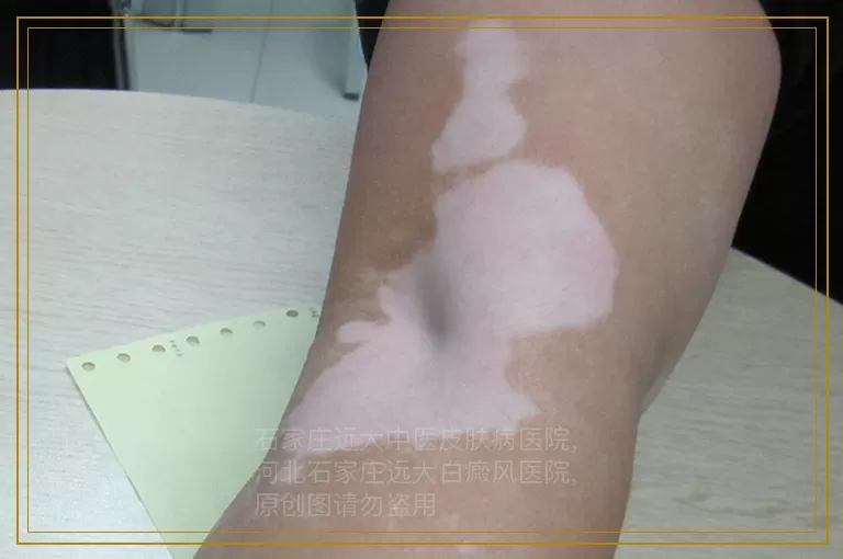 宝宝胳膊有白斑是白癜风吗