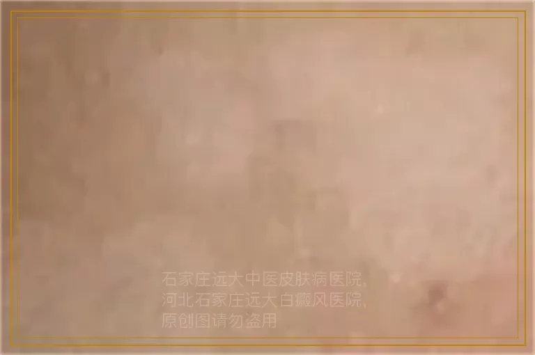 孩子脸上有两小块皮肤发白是怎么回事