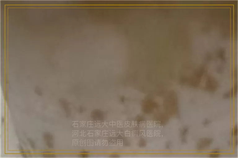 九岁小孩白癜风怎么治