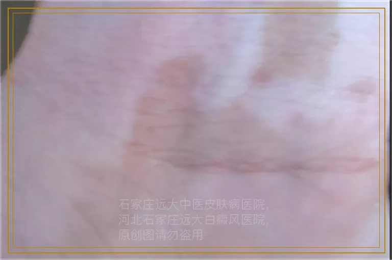 小孩手上发展期白癜风能打补骨脂吗