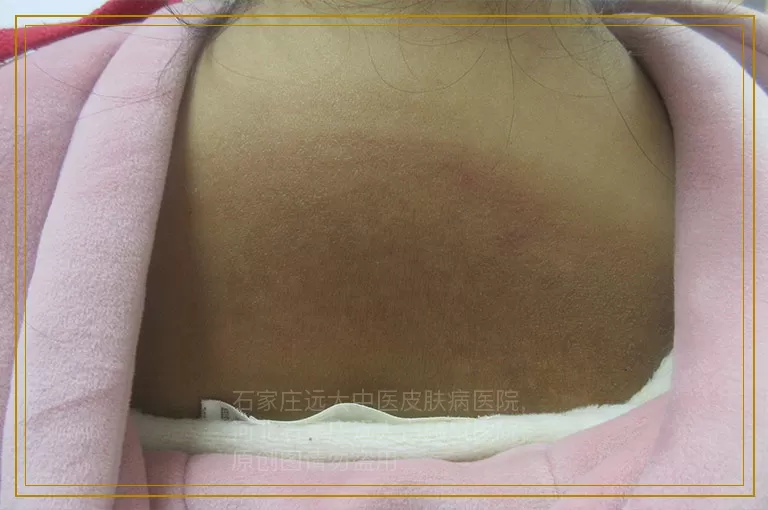 两岁宝宝脸上长了白癜风怎么办