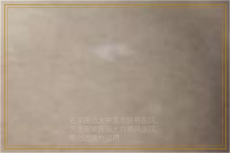 孩子肩膀白斑怎么回事是白癜风吗