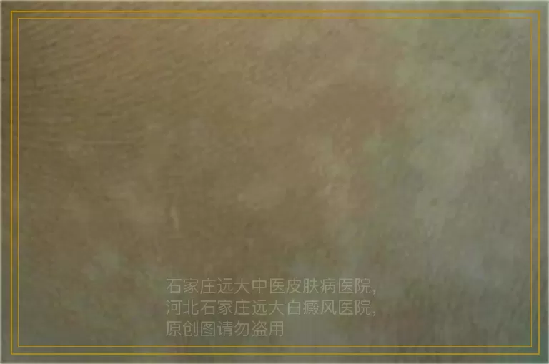 小女孩身上有块皮肤发白 白斑图片对比