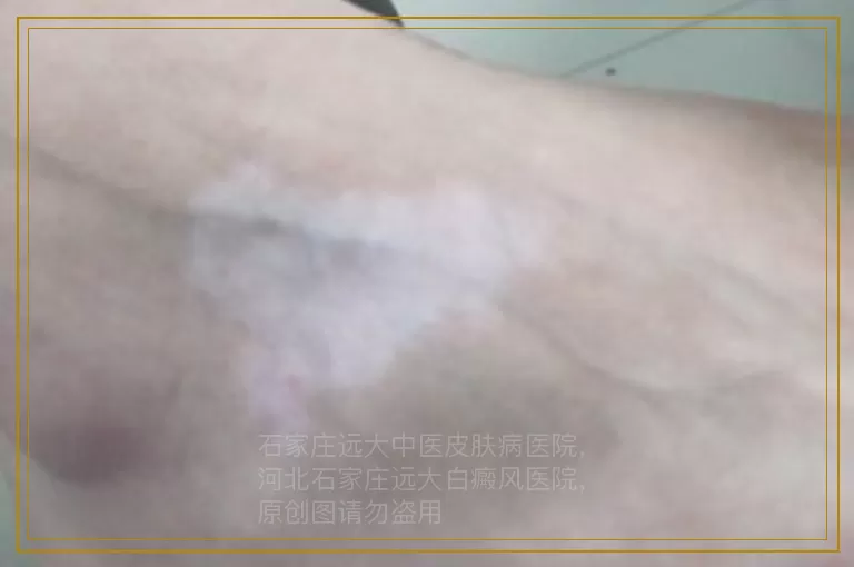 青少年白癜风的严峻形势