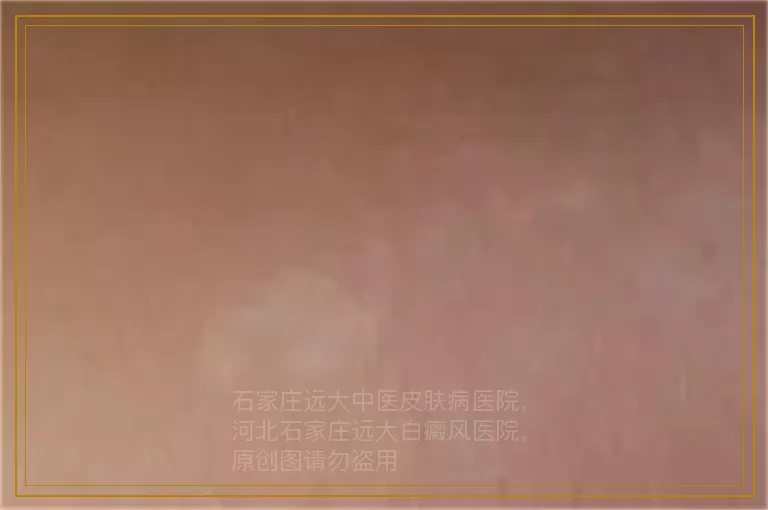 儿童白癜风发病的原因是什么呢