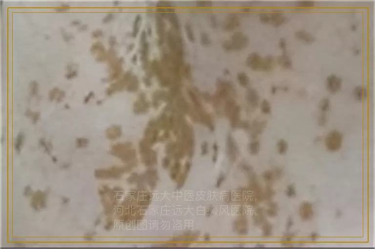 儿童白癜风扩散了该怎么治疗