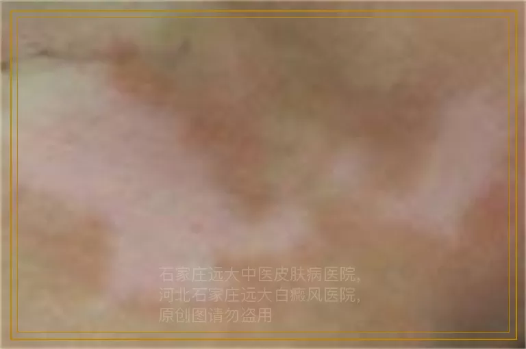 小孩肛门处白癜风治好后别的地方还会出现吗