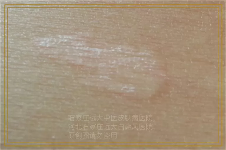 幼儿白斑的原因 预防白斑扩散的方法