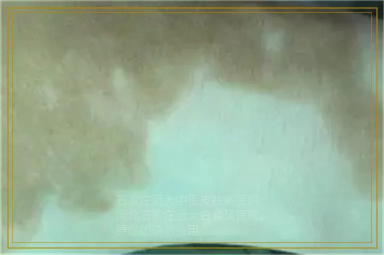 伍德灯下儿童手部白癜风是亮白色怎么治