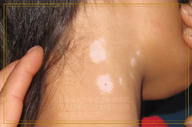 孩子后背出现了白癜风是什么原因