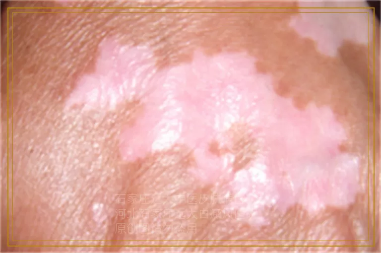 孩子三岁有白癜风什么办法能治