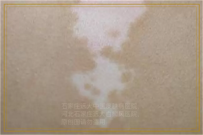 刚发现孩子腋下有块白斑能治好吗