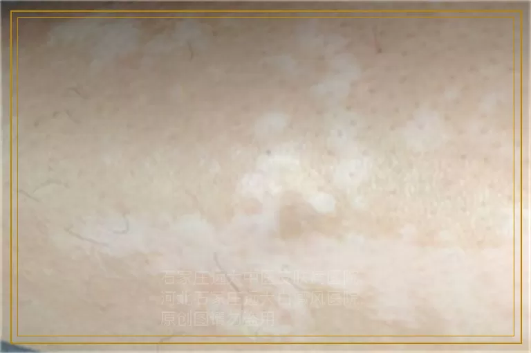 儿童身上白斑查伍德灯阳性是白癜风吗