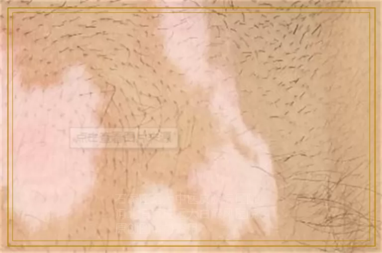 治疗儿童白癜风应该注意什么问题