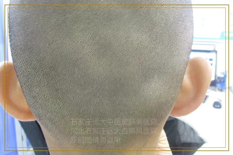 儿童哪些部位容易患白癜风呢