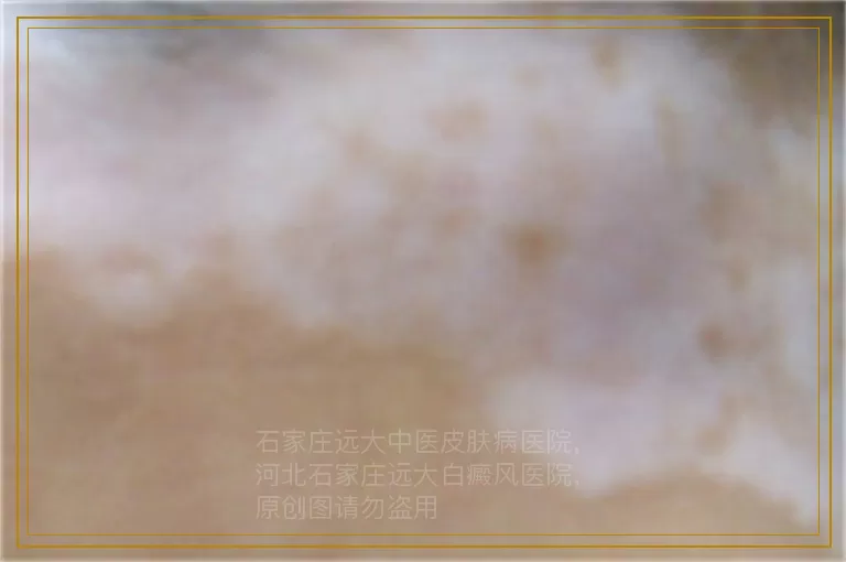 3周岁女宝脸上有白斑的原因是什么