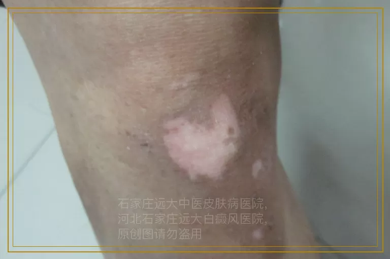 小孩子白癜风抹药不见好转怎么治能行