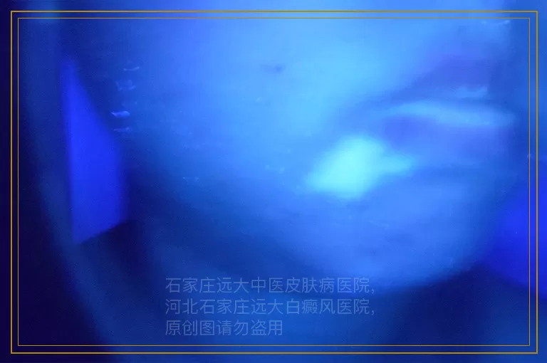 儿童长白癜风是怎么回事