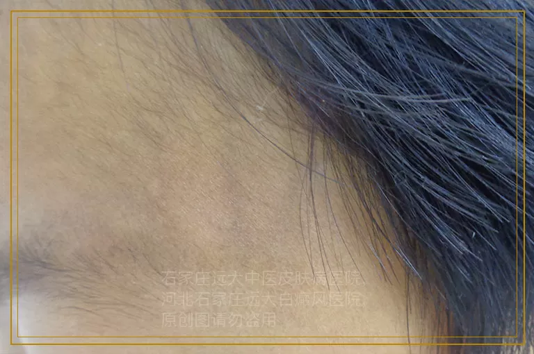 孩子眼角上面有块白斑是什么病