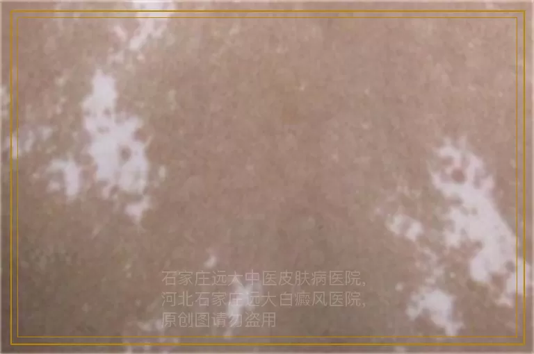 儿童白癜风已经治好还会复发吗