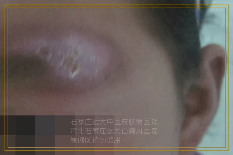 孩子白癜风照308有啥要注意的