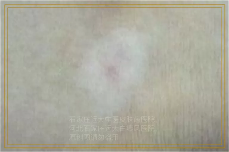 婴儿额头一大块白色斑点是什么