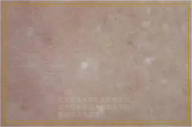 儿童眼眶白癜风做308激光有些地方明显好转还用照吗