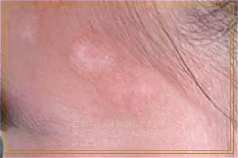 孩子手部长白癜风怎么治疗呢