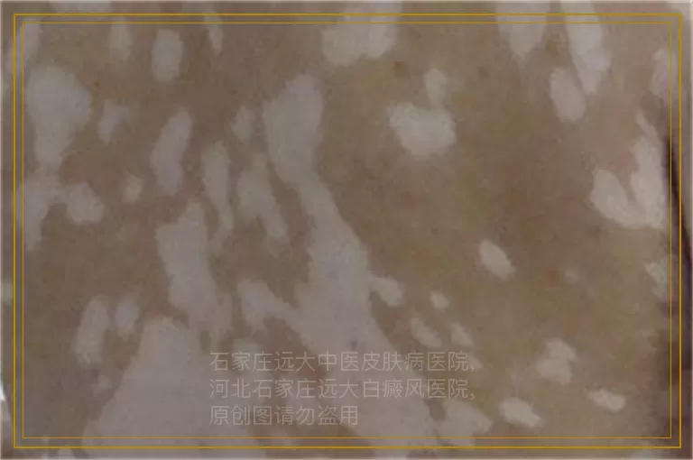 治疗儿童白癜风费用如何把控