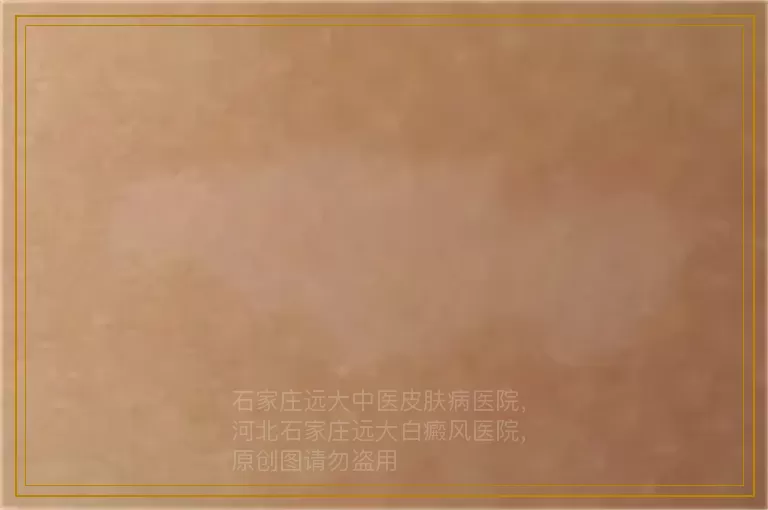 孩子有白癜风该怎么护理?