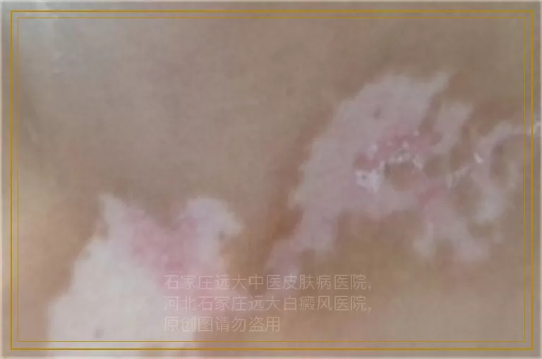 六个半月宝宝身上有白点