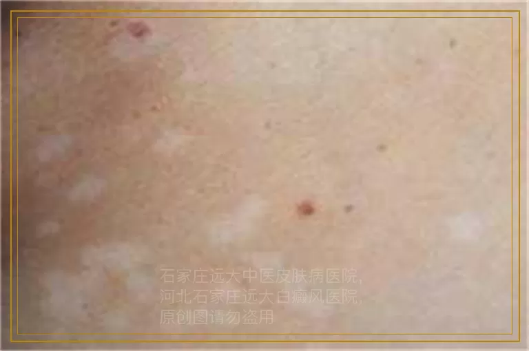 儿童患有白癜风需及时治疗