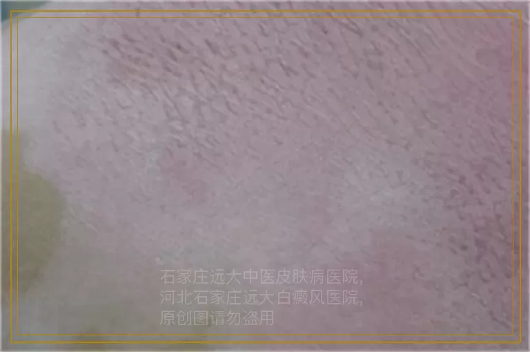 秋天宝宝手臂上长白色的点是什么