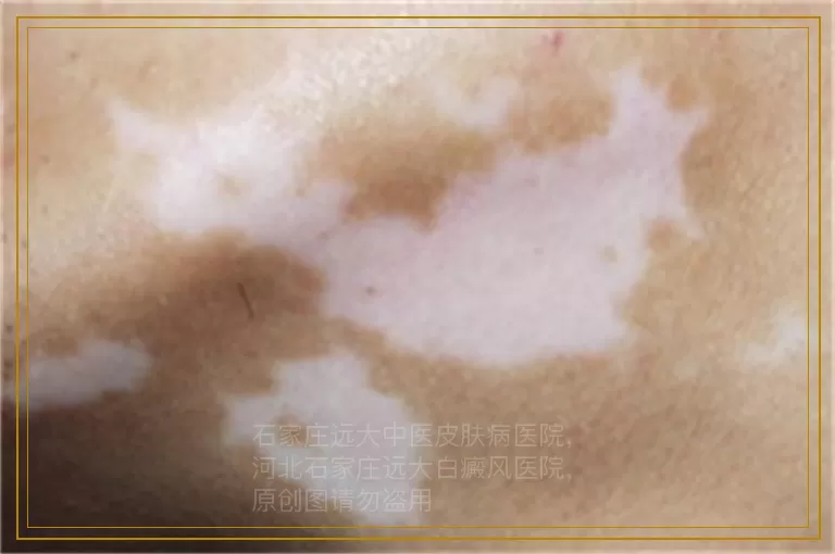 检测小孩白癜风比较准确的方法是什么