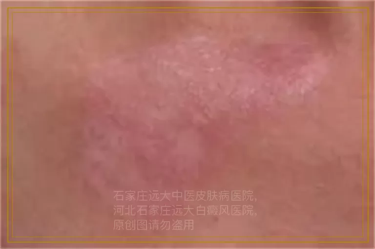 男孩手脚白癜风照一次激光多少钱