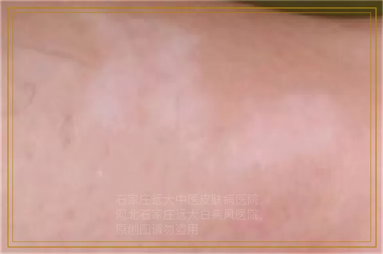 孩子胳膊上有好几块白斑是什么