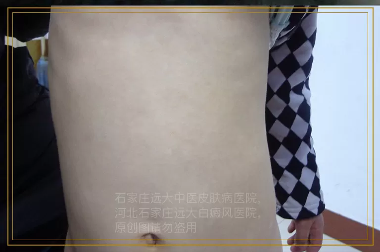 小孩腰部有白癜风还在扩散怎么办