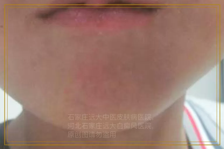 6岁小孩身上有一块白斑是怎么回事儿