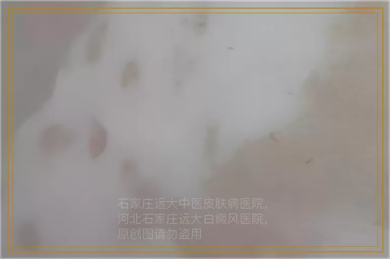 十岁儿子白癜风怎么治效果比较好