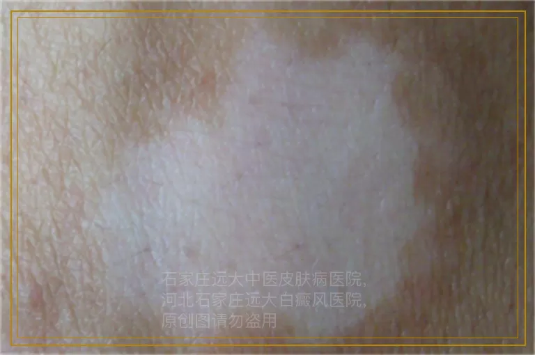 孩子正在上学，长白癜风会怎样