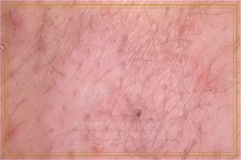 孩子脸上长白癜风是因为缺乏维生素吗