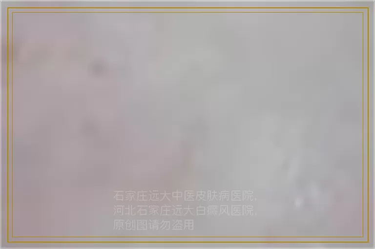 幼儿白癜风如何治疗安全系数高