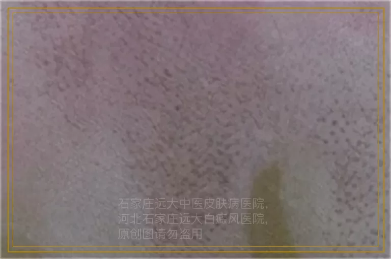 宝宝缺锌会导致额头长白斑