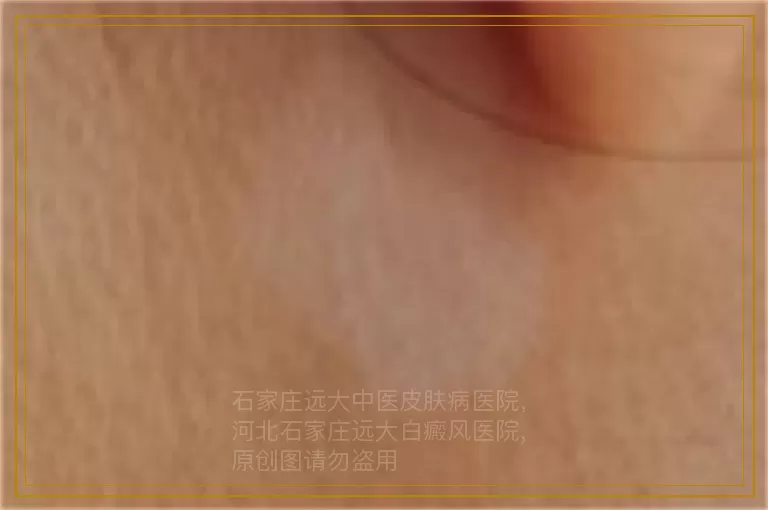 小孩身上有白斑的图片