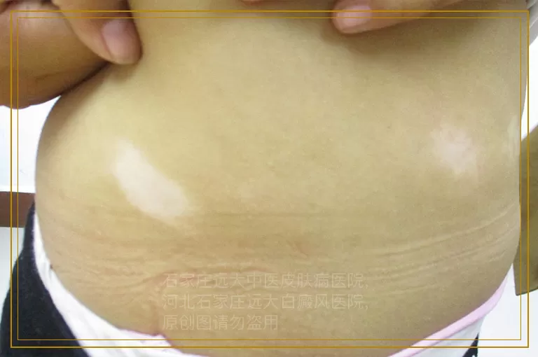 小孩子淡白色的斑点好几年了治疗效果不理想